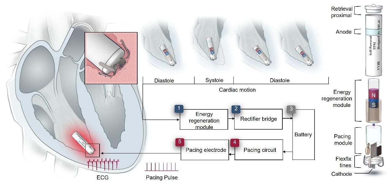 依靠心脏跳动自发电“终身免维护”无导线心脏起搏器研发成功(图1)