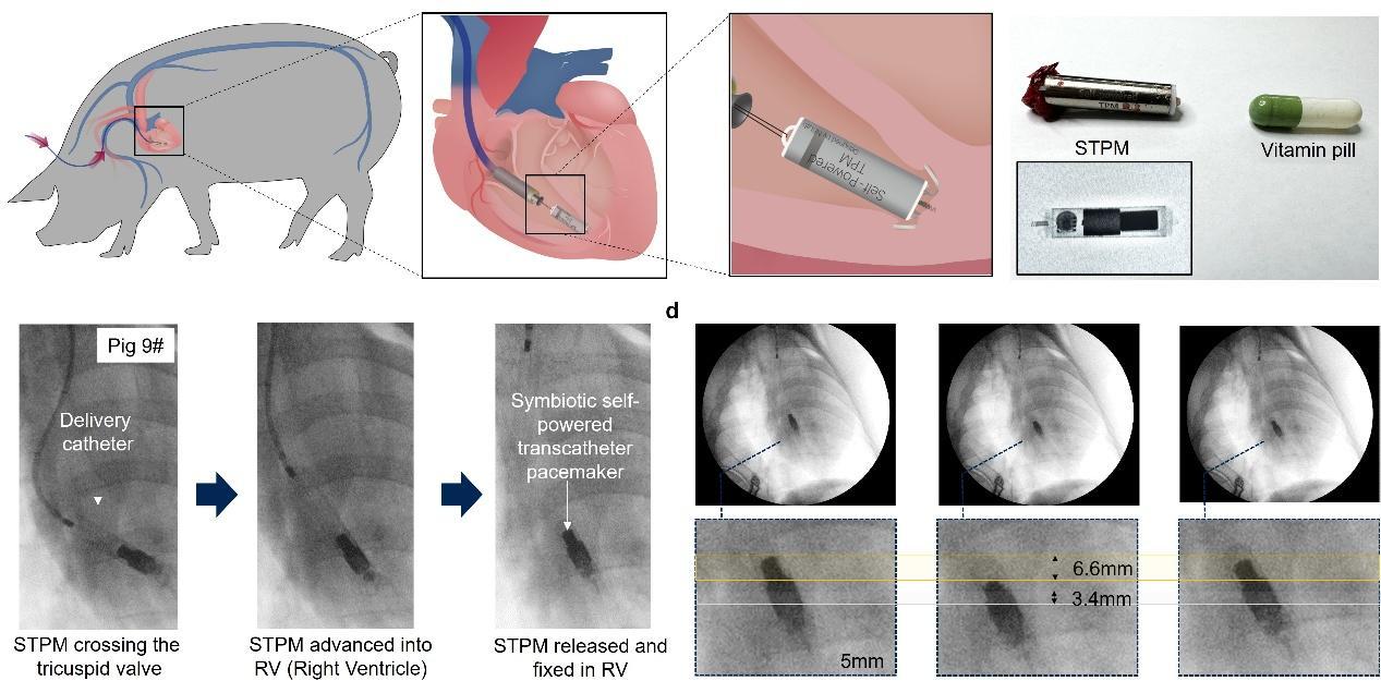 依靠心脏跳动自发电“终身免维护”无导线心脏起搏器研发成功(图2)